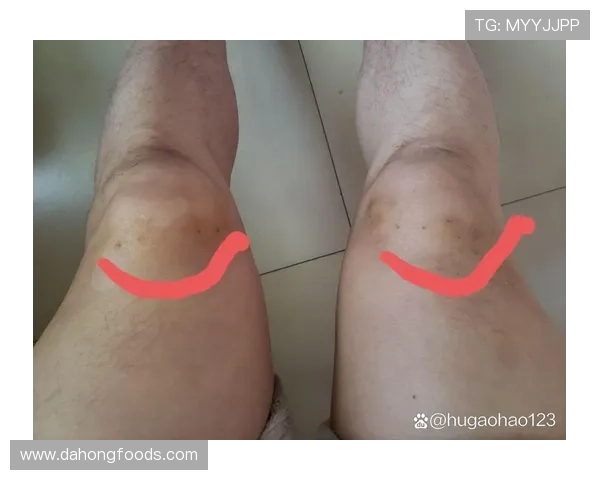 克勒贝尔训练意外受伤股四头肌拉伤将进行MRI检查